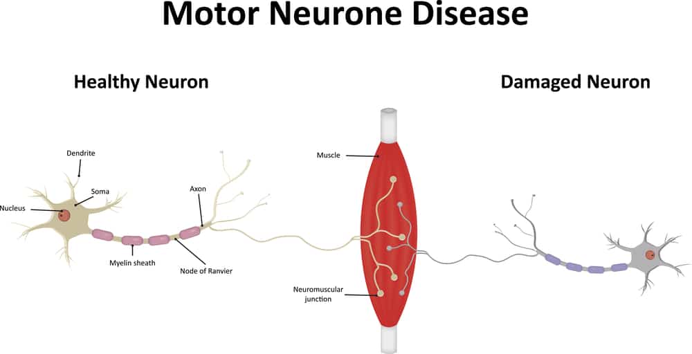 Currently, lots of research is being done to understand what causes MND and to find a cure. 