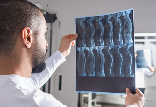 Radiologist analysing X-ray image of a spinal cord injury (SCI)