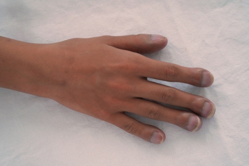 A close-up of a person's left hand resting on a white surface, showing fingers slightly spread apart, exhibiting signs of finger clubbing, a symptom associated with cystic fibrosis.